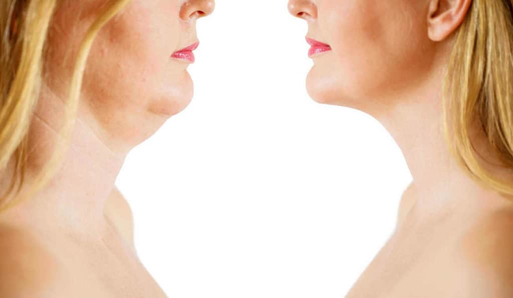 Double Chin treatment South Yorkshire before and after results