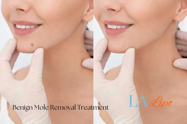 Before-and-after results following benign mole-removal treatment South Yorkshire
