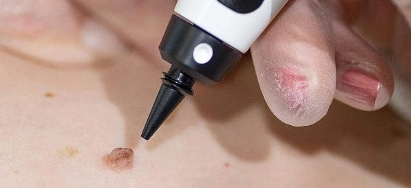 skin tag removal using cryopen South Yorkshire