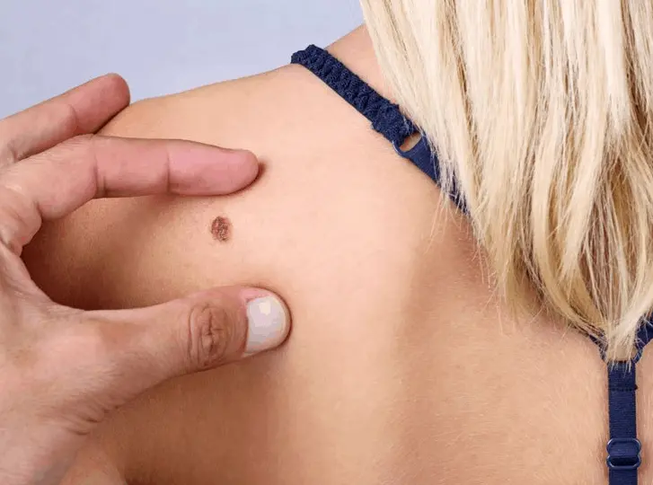 woman having mole removal South Yorkshire consultation before treatment.