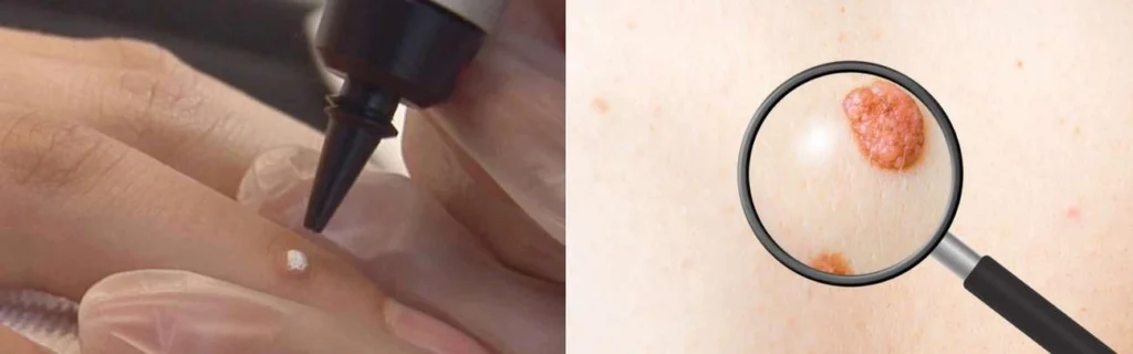 CryoPen practitioner South Yorkshire assessing a benign mole before treatment