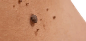 image of a skin tag South Yorkshire