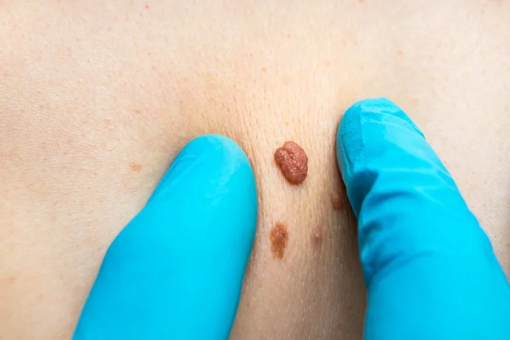 Consultant examining a skin tag South Yorkshire