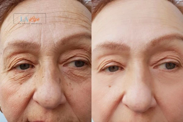 The powerful benefits of Morpheus8 Treatment South Yorkshire - Call Our team today!
