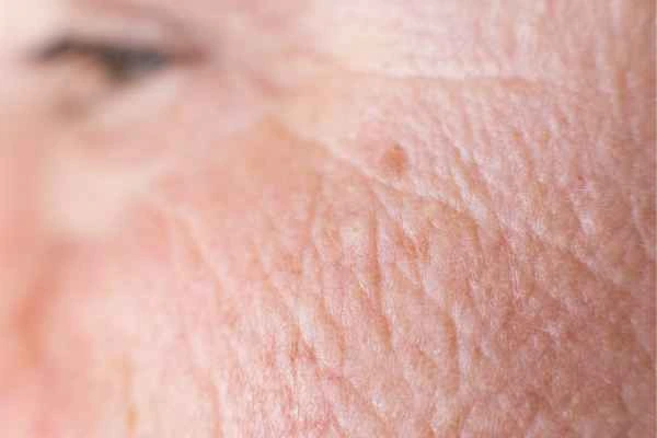 close up picture of a woman's face showing an age spot South Yorkshire