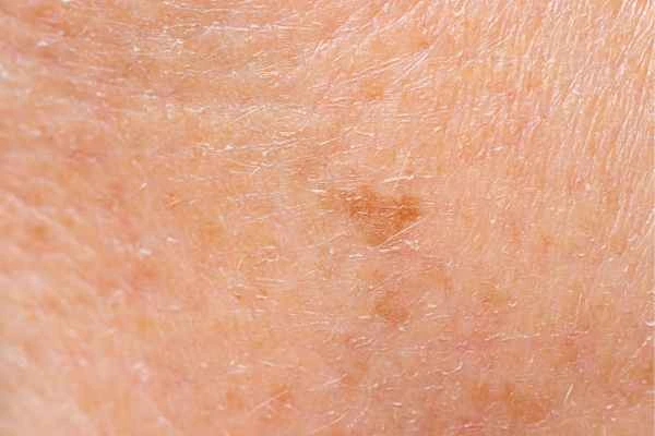 close up picture of age spots South Yorkshire