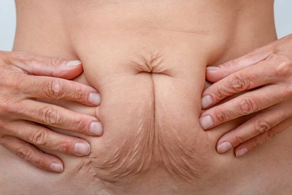 Image of a woman's stomach with loose skin - example of skin tightening South Yorkshire options