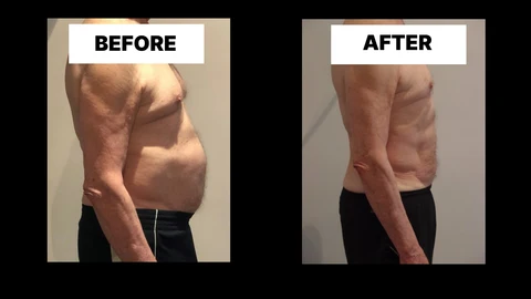 What Symptoms Can Diastasis Recti Cause in Men? Weak Core, Back Pain and Poor Posture South Yorkshire